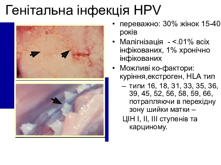 Генітальна інфекція HPV переважно: 30% жінок 15-40 років Малігнізація -