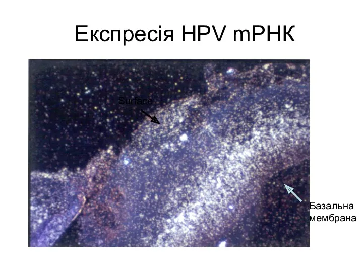 Експресія HPV mРНК Базальна мембрана Surface
