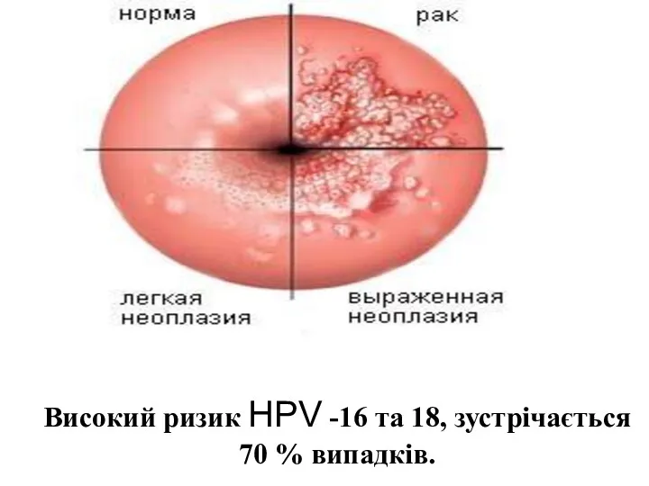 Високий ризик HPV -16 та 18, зустрічається 70 % випадків.