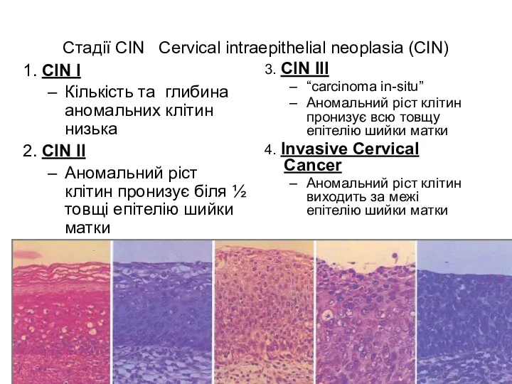 Стадії CIN Cervical intraepithelial neoplasia (CIN) 1. CIN I Кількість