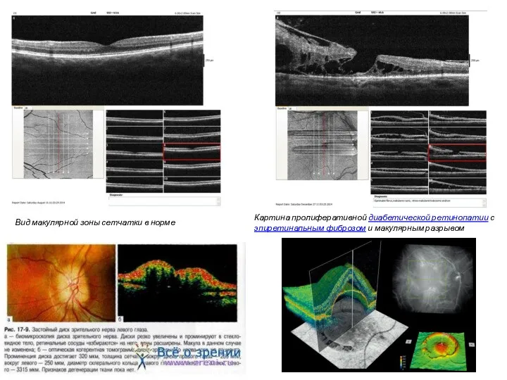 Вид макулярной зоны сетчатки в норме Картина пролиферативной диабетической ретинопатии с эпиретинальным фиброзом и макулярным разрывом