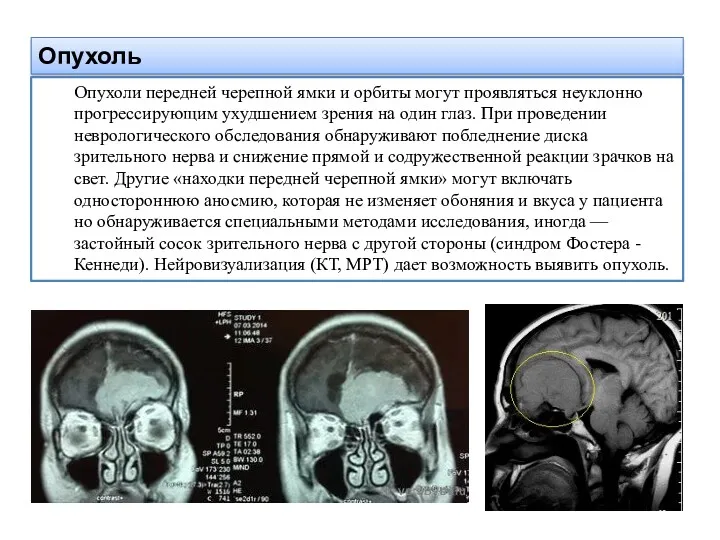 Опухоль Опухоли передней черепной ямки и орбиты могут проявляться неуклонно