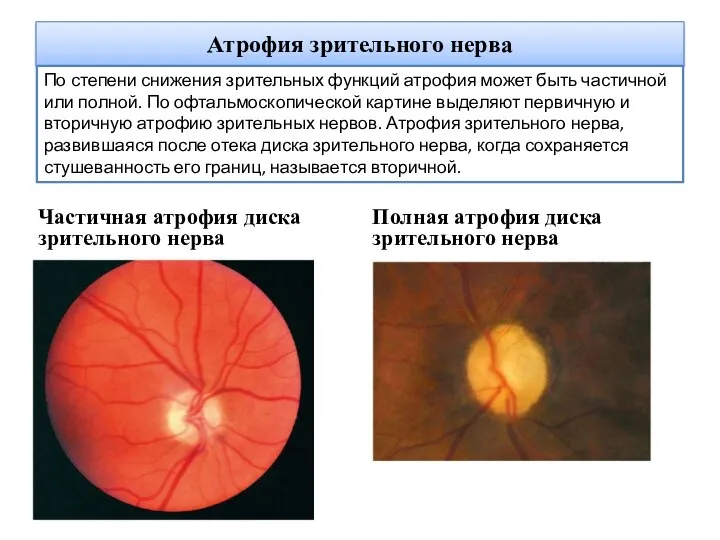 Атрофия зрительного нерва Частичная атрофия диска зрительного нерва Полная атрофия