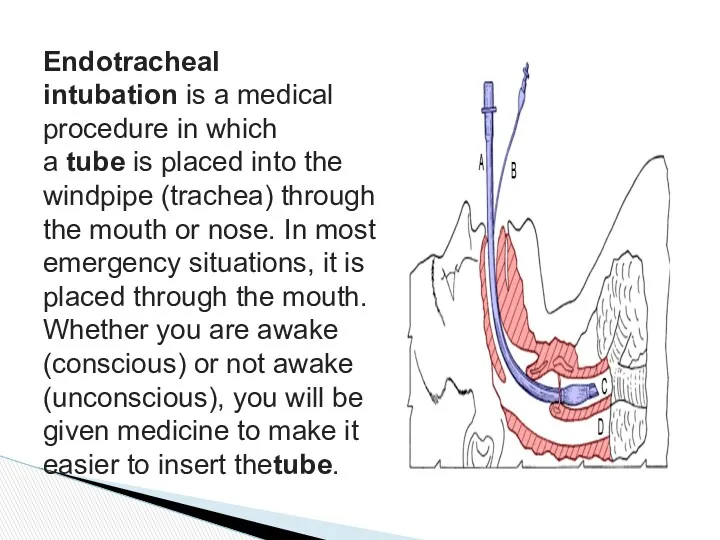 Endotracheal intubation is a medical procedure in which a tube