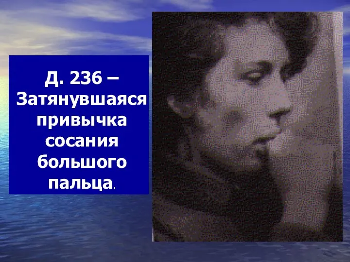 Д. 236 – Затянувшаяся привычка сосания большого пальца.