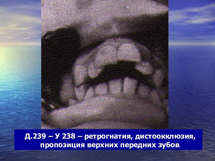 Д.239 – У 238 – ретрогнатия, дистоокклюзия, пропозиция верхних передних зубов.