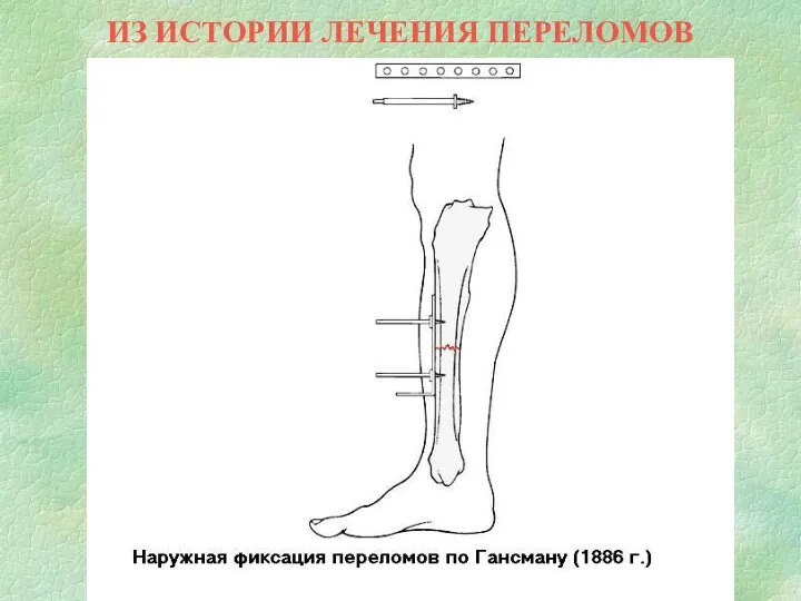 ИЗ ИСТОРИИ ЛЕЧЕНИЯ ПЕРЕЛОМОВ