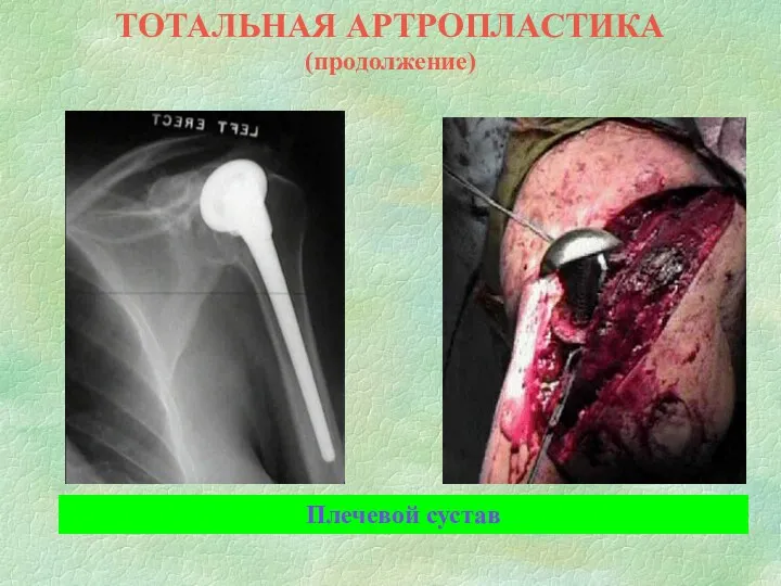 ТОТАЛЬНАЯ АРТРОПЛАСТИКА (продолжение) Плечевой сустав