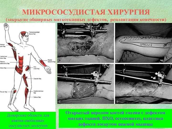 МИКРОСОСУДИСТАЯ ХИРУРГИЯ (закрытие обширных мягкотканных дефектов, реплантация конечности) Донорские области