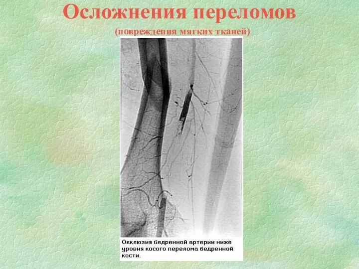 Осложнения переломов (повреждения мягких тканей)