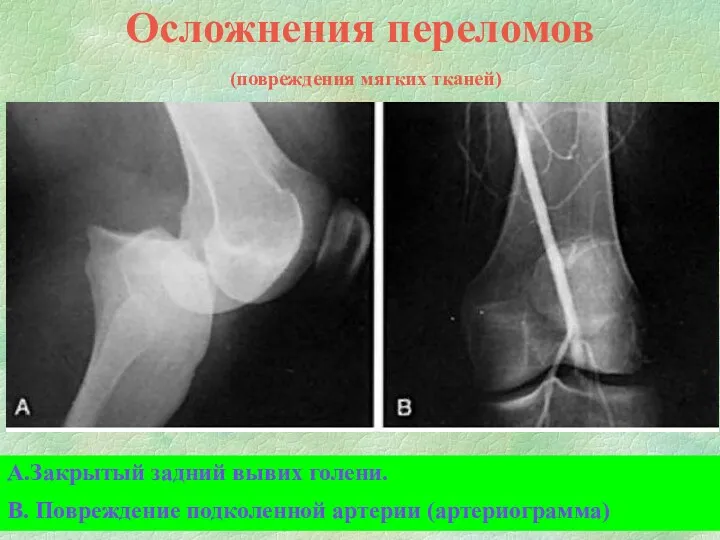 Осложнения переломов (повреждения мягких тканей) А.Закрытый задний вывих голени. В. Повреждение подколенной артерии (артериограмма)