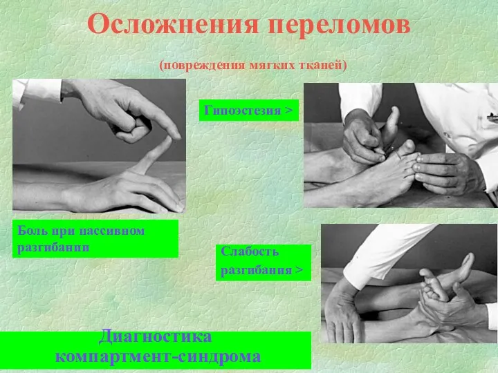 Осложнения переломов (повреждения мягких тканей) Боль при пассивном разгибании Гипоэстезия > Слабость разгибания > Диагностика компартмент-синдрома