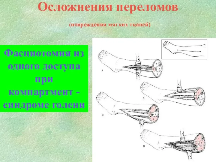 Осложнения переломов (повреждения мягких тканей) Фасциотомия из одного доступа при компартмент - синдроме голени