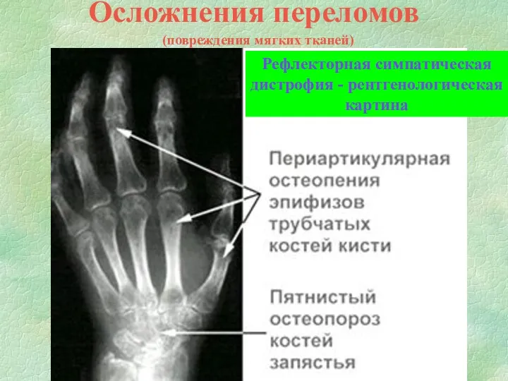 Осложнения переломов (повреждения мягких тканей) Рефлекторная симпатическая дистрофия - рентгенологическая картина