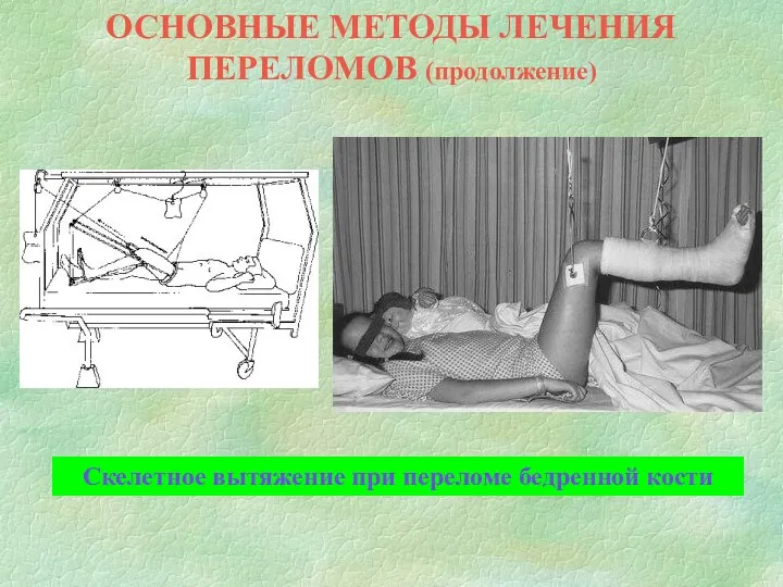 ОСНОВНЫЕ МЕТОДЫ ЛЕЧЕНИЯ ПЕРЕЛОМОВ (продолжение) Скелетное вытяжение при переломе бедренной кости