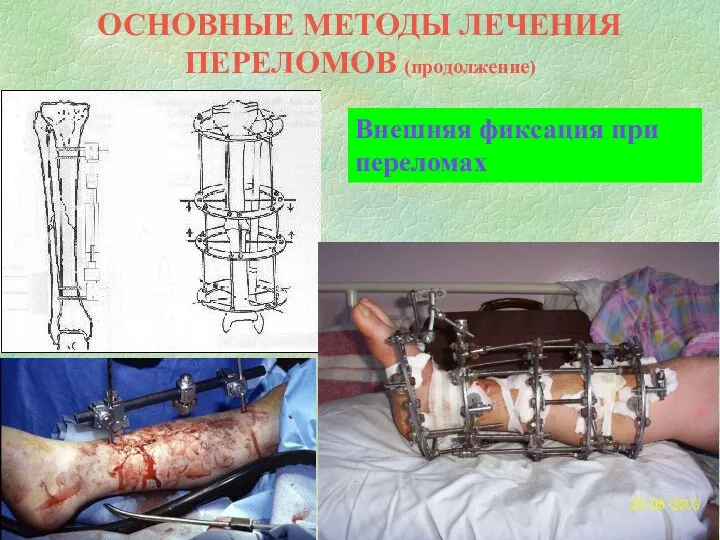 ОСНОВНЫЕ МЕТОДЫ ЛЕЧЕНИЯ ПЕРЕЛОМОВ (продолжение) Внешняя фиксация при переломах