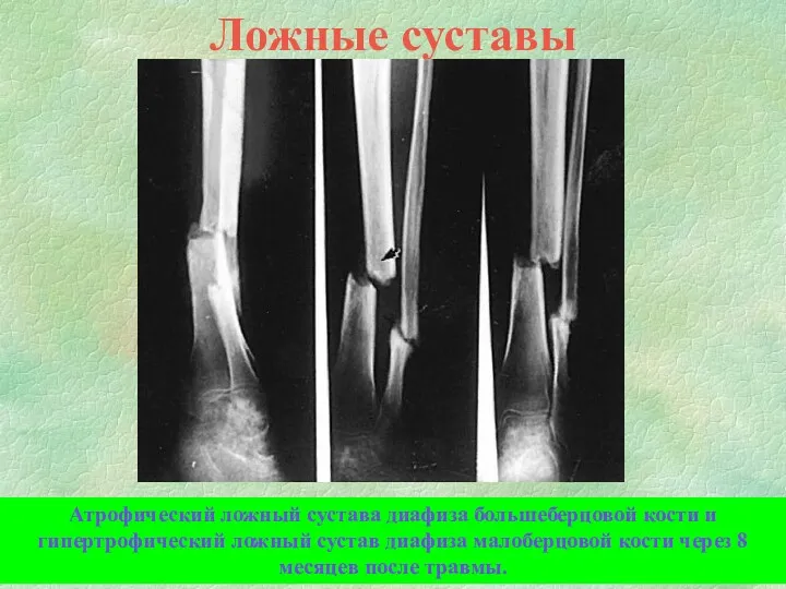 Ложные суставы Атрофический ложный сустава диафиза большеберцовой кости и гипертрофический