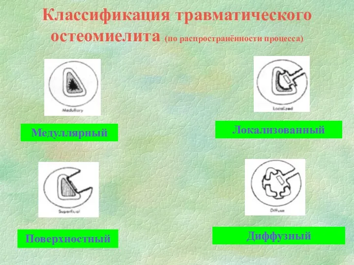 Классификация травматического остеомиелита (по распространённости процесса) Медуллярный Локализованный Поверхностный Диффузный