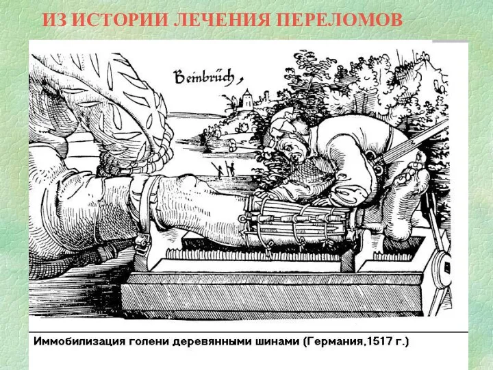 ИЗ ИСТОРИИ ЛЕЧЕНИЯ ПЕРЕЛОМОВ