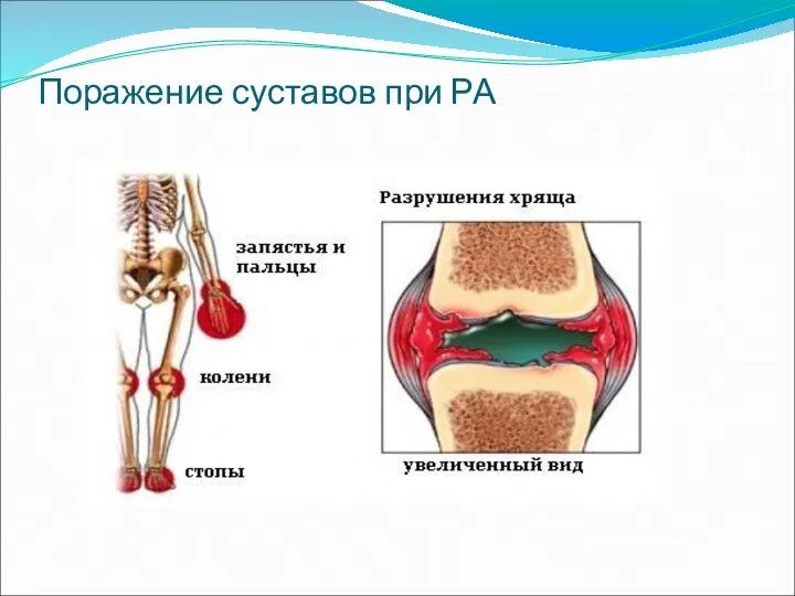 Поражение суставов при РА