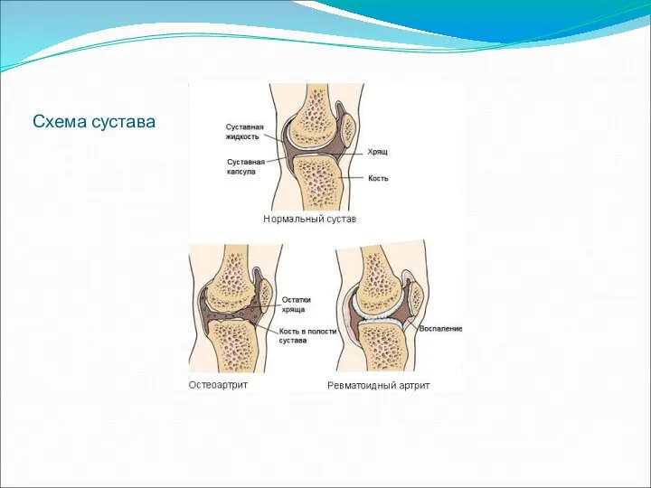 Схема сустава