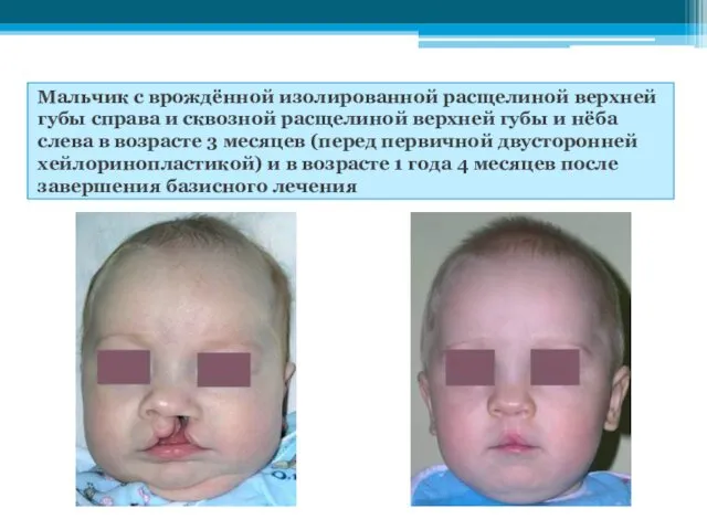 Мальчик с врождённой изолированной расщелиной верхней губы справа и сквозной