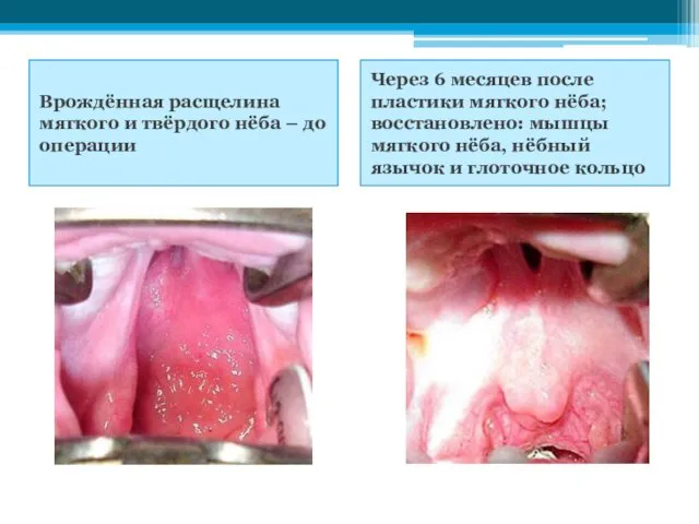 Врождённая расщелина мягкого и твёрдого нёба – до операции Через