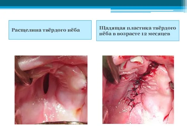 Расщелина твёрдого нёба Щадящая пластика твёрдого нёба в возрасте 12 месяцев