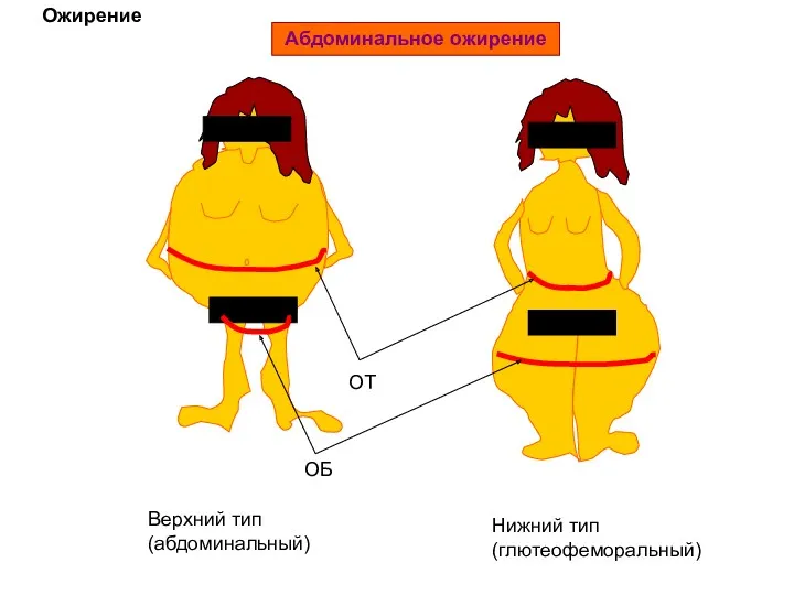 Ожирение Абдоминальное ожирение ОТ ОБ Верхний тип (абдоминальный) Нижний тип (глютеофеморальный)