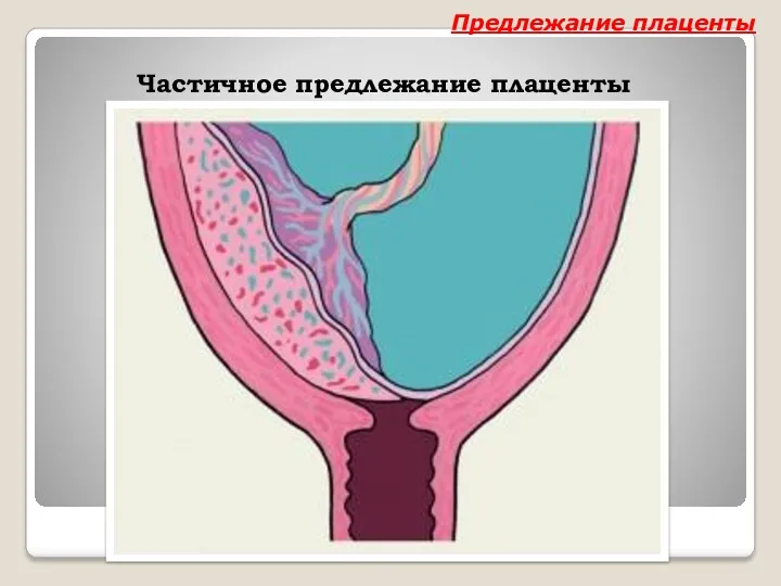 Частичное предлежание плаценты Предлежание плаценты