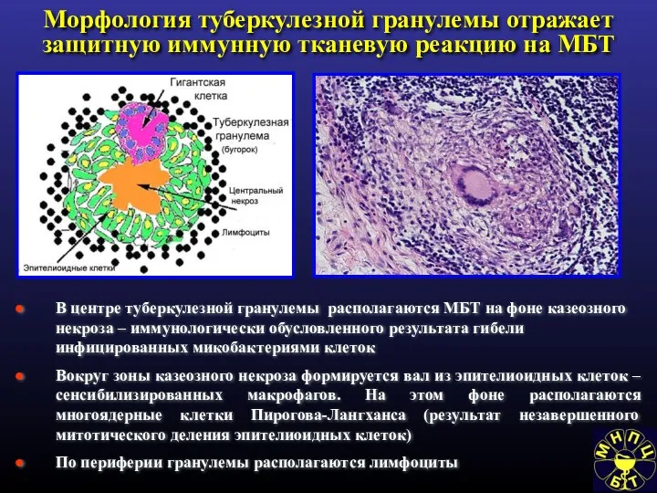 Морфология туберкулезной гранулемы отражает защитную иммунную тканевую реакцию на МБТ В центре туберкулезной