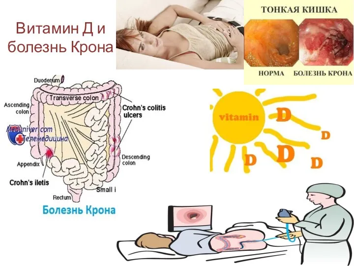 Витамин Д и болезнь Крона