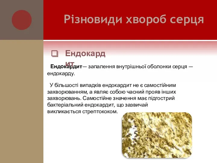 Ендокардит— запалення внутрішньої оболонки серця — ендокарду. У більшості випадків