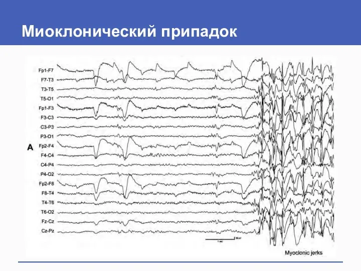 Миоклонический припадок