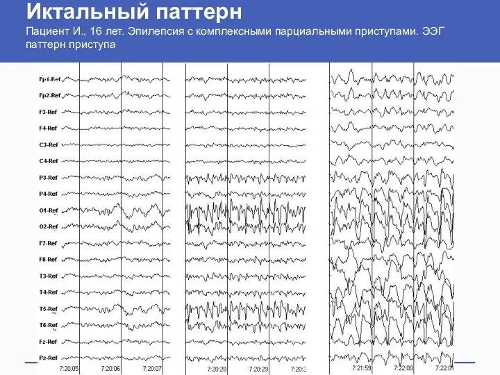 Иктальный паттерн Пациент И., 16 лет. Эпилепсия с комплексными парциальными приступами. ЭЭГ паттерн приступа