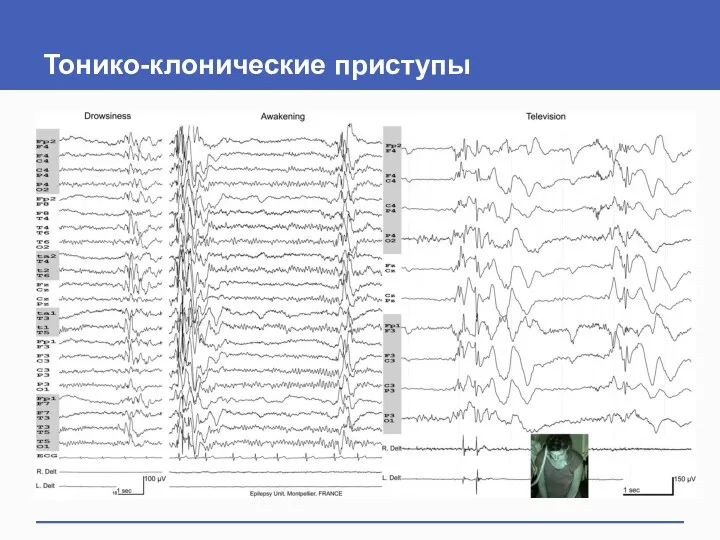 Тонико-клонические приступы