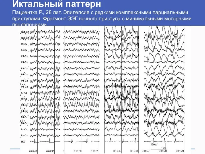 Иктальный паттерн Пациентка Р., 28 лет. Эпилепсия с редкими комплексными