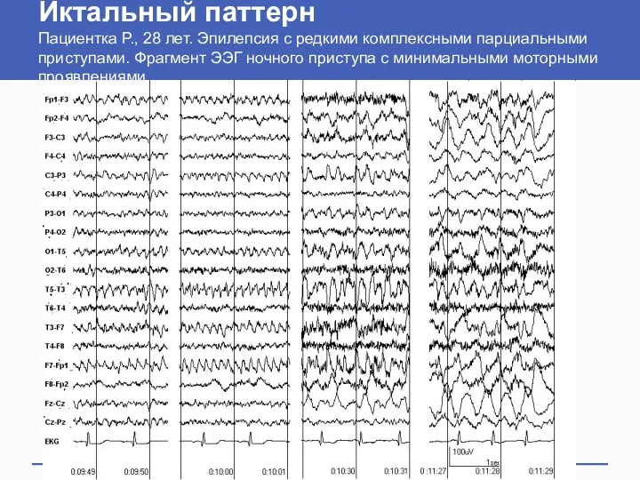 Иктальный паттерн Пациентка Р., 28 лет. Эпилепсия с редкими комплексными