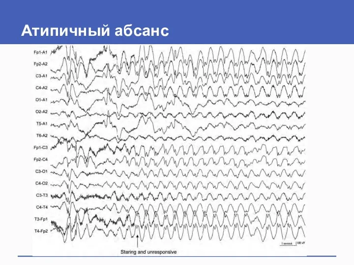 Атипичный абсанс