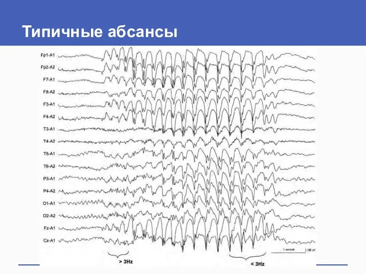 Типичные абсансы