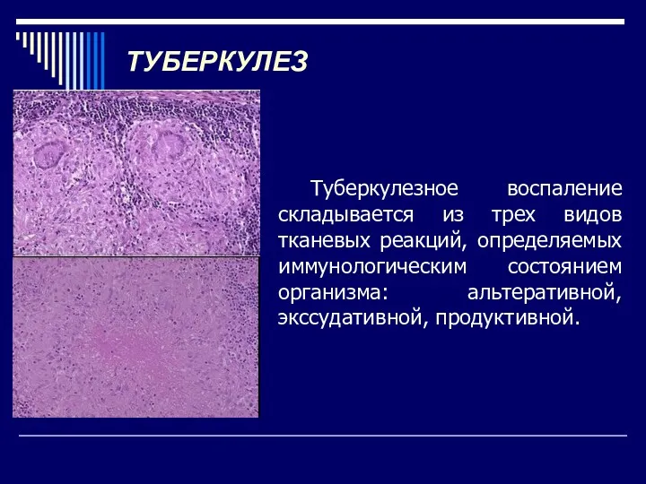 ТУБЕРКУЛЕЗ Туберкулезное воспаление складывается из трех видов тканевых реакций, определяемых иммунологическим состоянием организма: альтеративной, экссудативной, продуктивной.