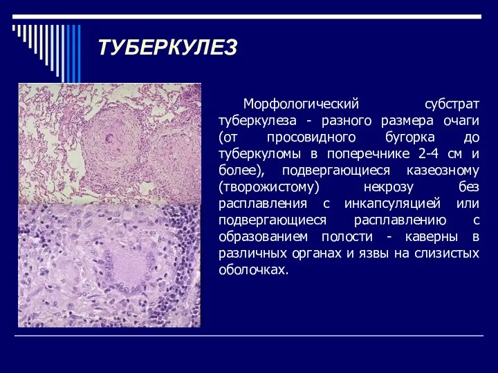 ТУБЕРКУЛЕЗ Морфологический субстрат туберкулеза - разного размера очаги (от просовидного