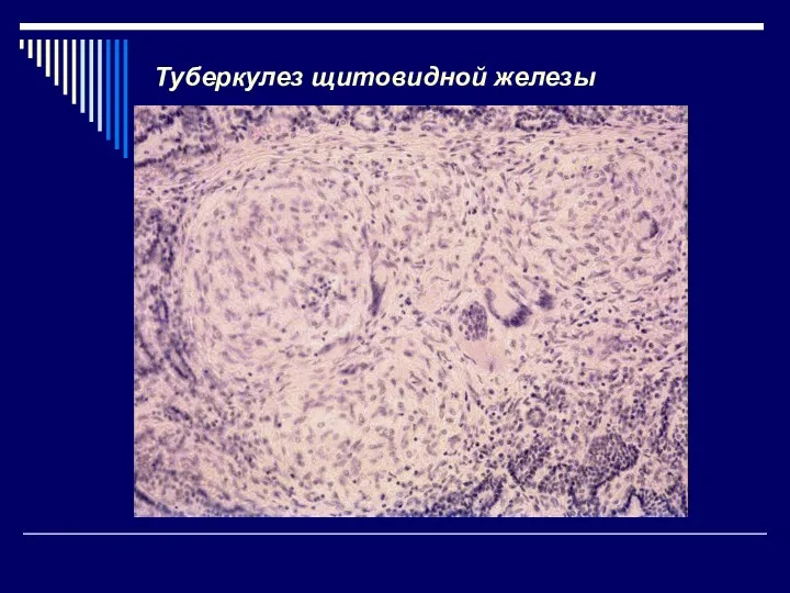 Туберкулез щитовидной железы