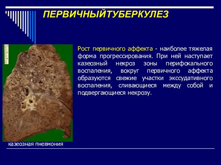 ПЕРВИЧНЫЙТУБЕРКУЛЕЗ Рост первичного аффекта - наиболее тяжелая форма прогрессирования. При