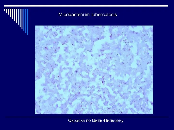 Micobacterium tuberculosis Окраска по Циль-Нильсену