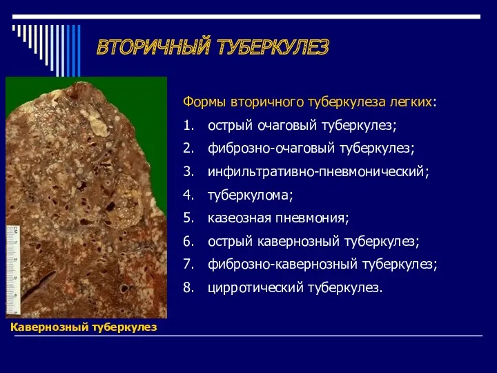 ВТОРИЧНЫЙ ТУБЕРКУЛЕЗ Формы вторичного туберкулеза легких: 1. острый очаговый туберкулез;