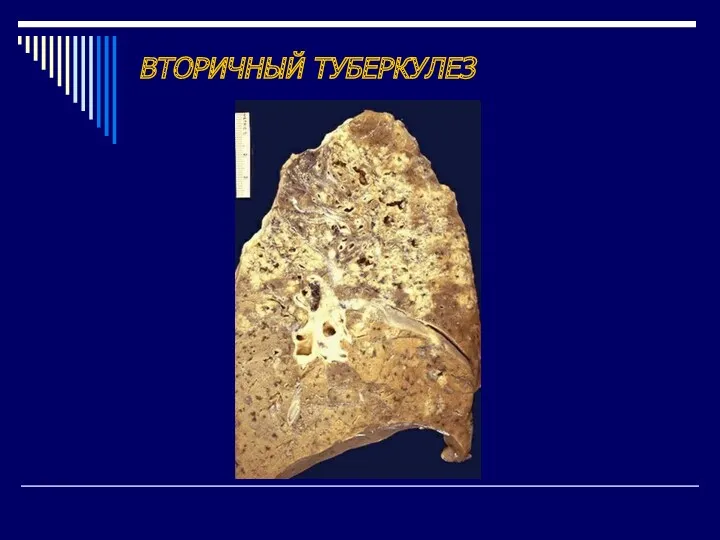 ВТОРИЧНЫЙ ТУБЕРКУЛЕЗ