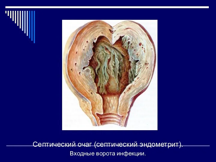 Септический очаг (септический эндометрит). Входные ворота инфекции.