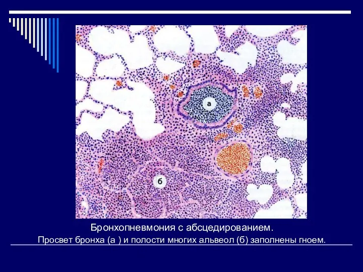 Бронхопневмония с абсцедированием. Просвет бронха (а ) и полости многих альвеол (б) заполнены гноем.