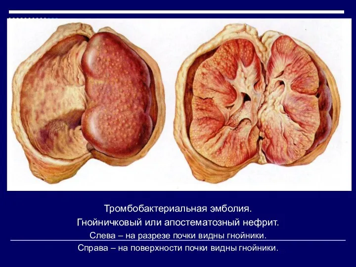 Тромбобактериальная эмболия. Гнойничковый или апостематозный нефрит. Слева – на разрезе